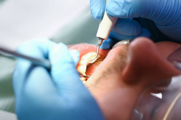 Best Emergency Dental Care for Broken or Chipped Teeth in Warsaw, KY